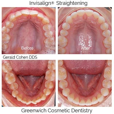 Invisalign Orthodontic Correction - Greenwich Cosmetic Dentistry