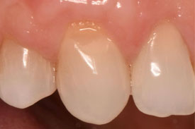 Invisalign & Veneers - After | Greenwich CT Dentist | Greenwich Cosmetic Dentistry